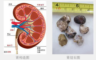 腎結石注意事項及飲食