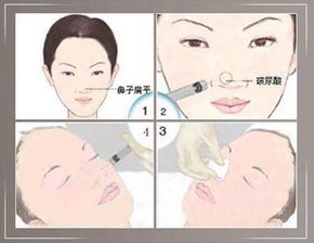 鼻子打完波尿酸注意事項