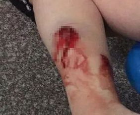 狗咬傷注意事項,蛇咬傷注意事項,被貓咬傷注意事項
