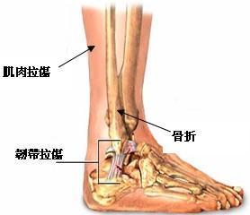 腳踝,應注意,骨折,事項