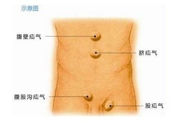 小腸氣手術(shù)后飲食注意事項,老年人小腸氣手術(shù)后注意事項,小腸氣手術(shù)前注意事項